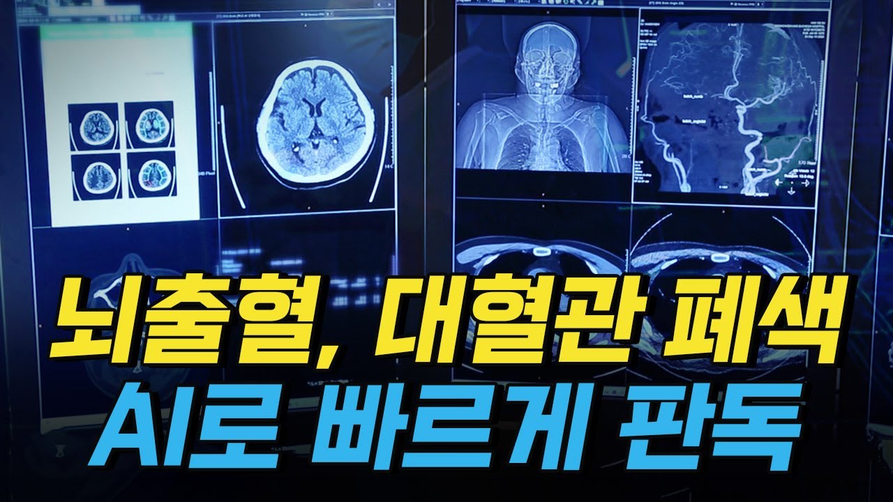 [핫클립] AI 기반 응급 뇌졸중 선별 솔루션
