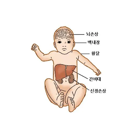 갈락토스혈증(galactosemia,-血症)