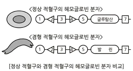 낫 모양 적혈구 빈혈증(sickle-cell anemia)