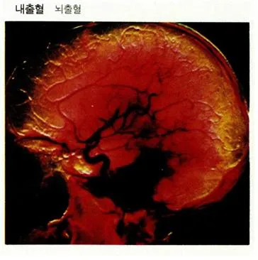 내출혈(internal bleeding, 內出血)