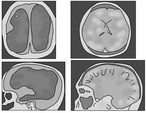 대뇌 속질 (cerebrum medulla )大腦-質	