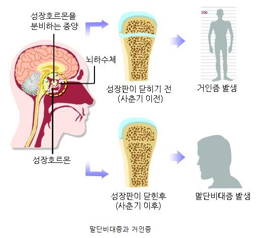 말단비대증