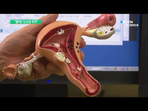 [사이언스 TV] 젊어도 난소암 주의…20대 환자 5년 새 48% 증가
