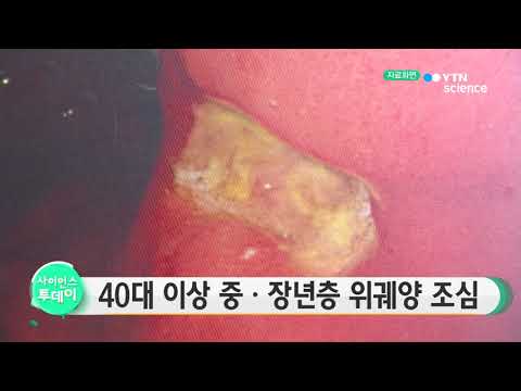 [사이언스 TV] 40대 이상 중·장년층 위궤양 조심
