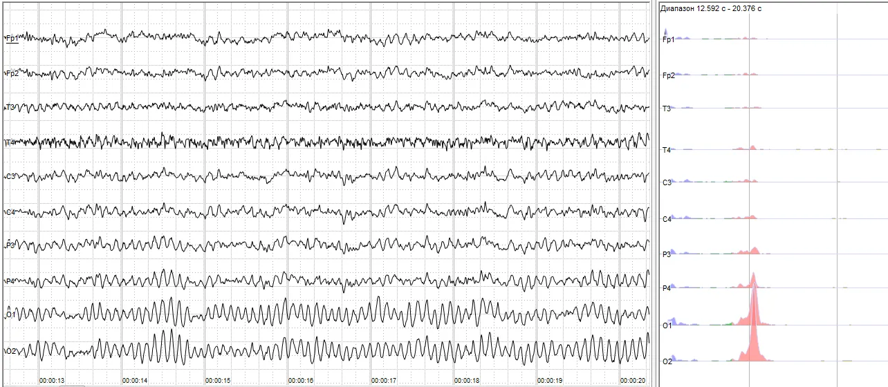 뇌전도(EEG : electroencephalogram)