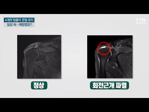 [사이언스TV] 단순한 오십견인줄 알았더니 회전근개 파열