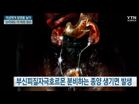 열심히 운동해도 살이 찌는 '쿠싱증후군'
