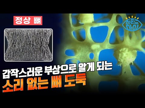 비타민D를 잘 먹어야 이것을 예방할 수 있다 🍊 [#X파일]