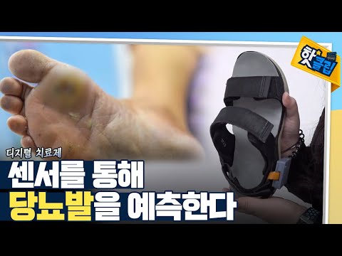 [핫클립] 당뇨발을 진단하는 디지털 치료제