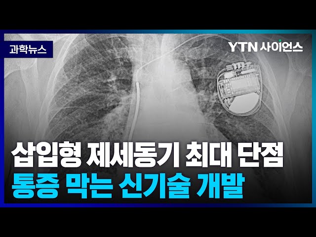 [과학뉴스] 국내연구진, 삽입형 제세동기 단점인 통증 막는 기술 개발