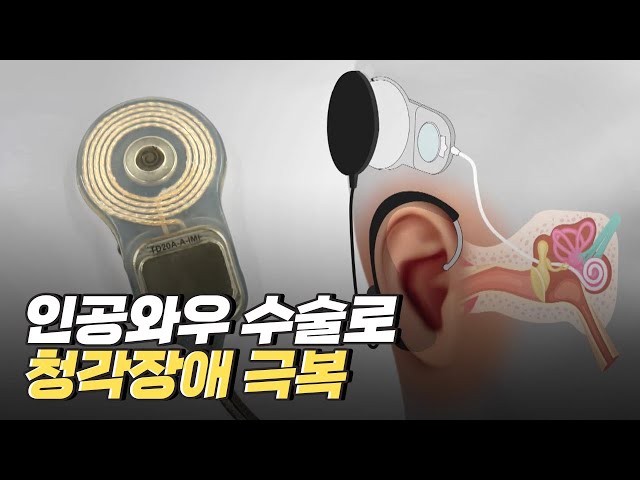 [핫클립] 청각 장애인들도 소리를 들을 수 있는 인공와우