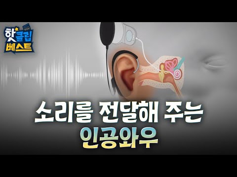 [핫클립 베스트] 청각 장애인들도 소리를 들을 수 있는 인공와우